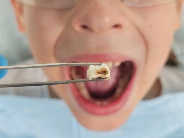 Best Emergency Treatment for Dental Infections or Abscesses in Ingram, TX